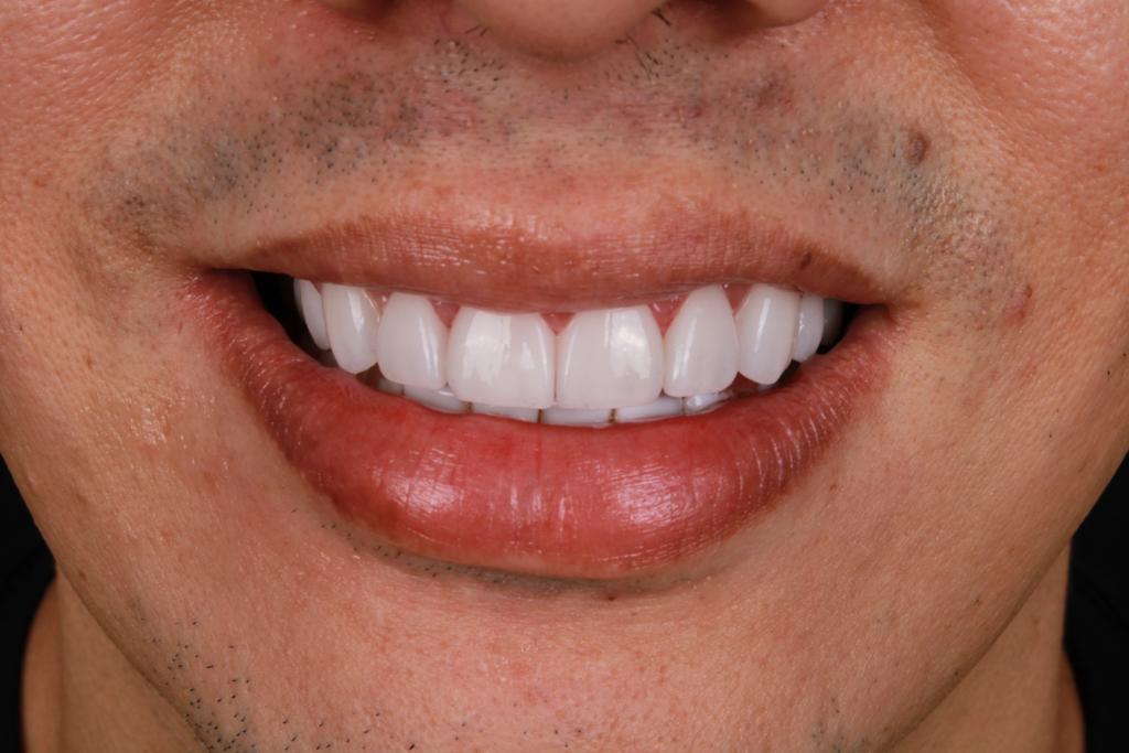 Después diseño dental